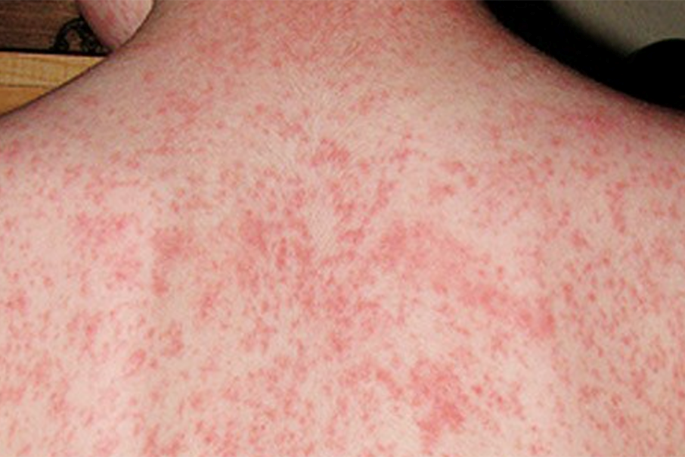 Measles is highly contagious and the virus is circulating in New Zealand